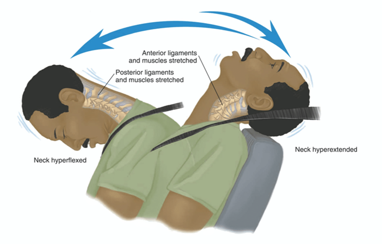 can a car accident cause a herniated disc